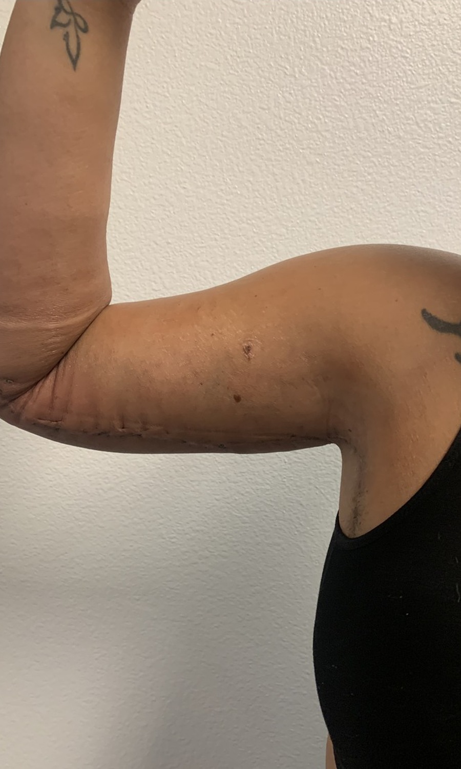 Arm Lift