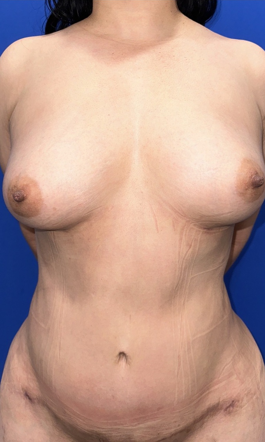 Fat Transfer to Breast