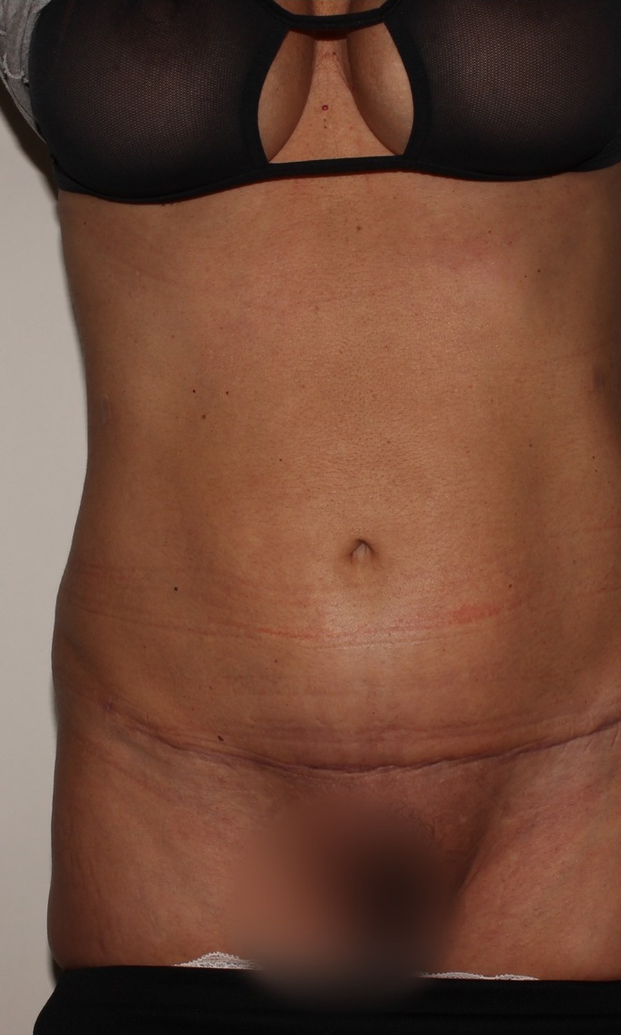 Hybrid Tuck