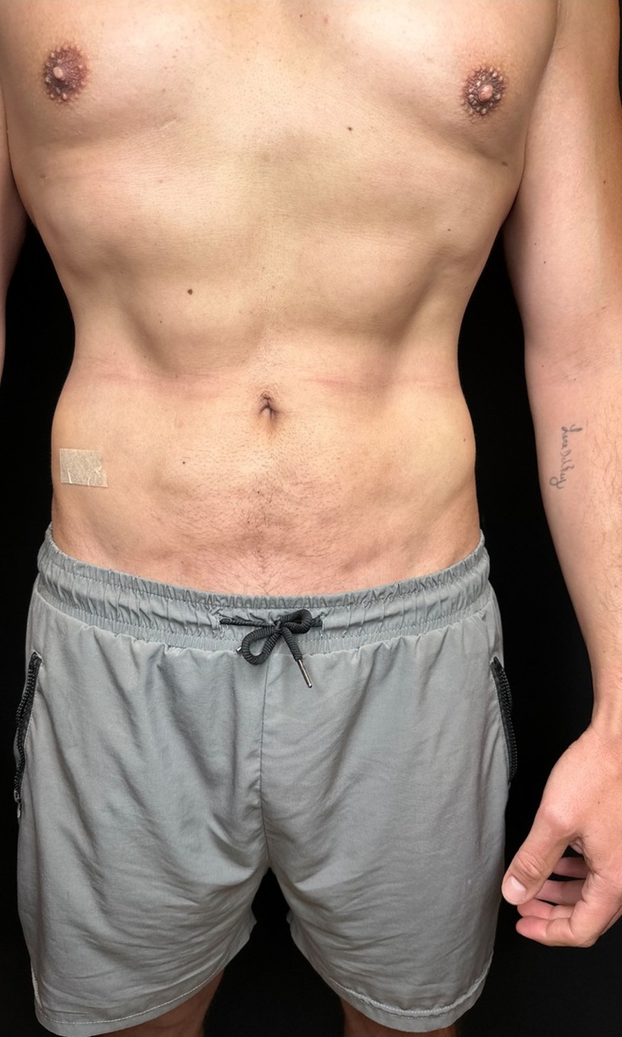 Liposuction + Renuvion J-Plasma