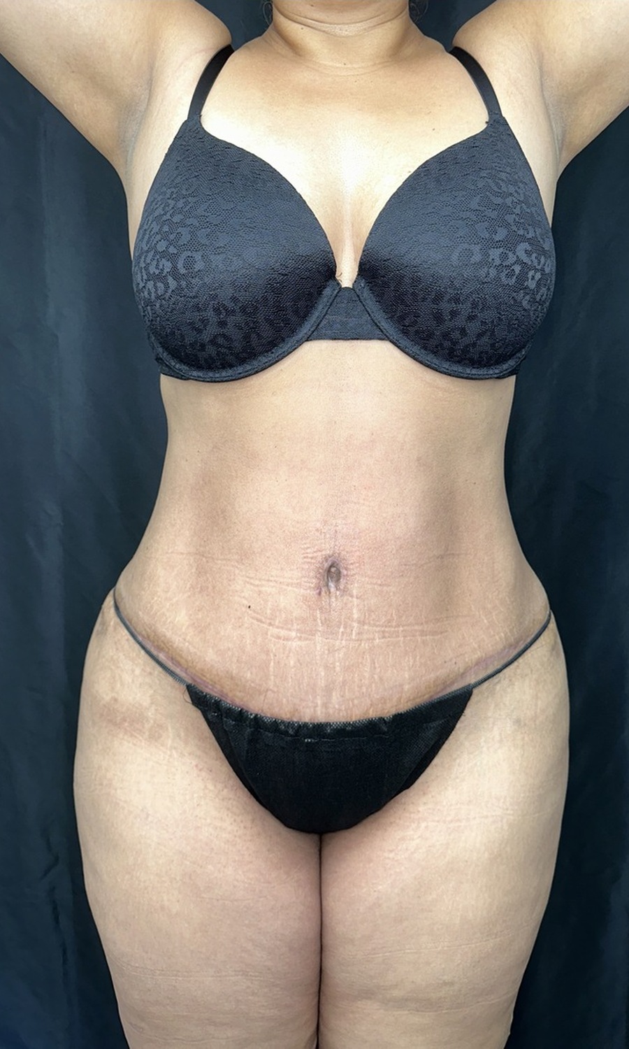 Abdominoplasty (Tummy Tuck)